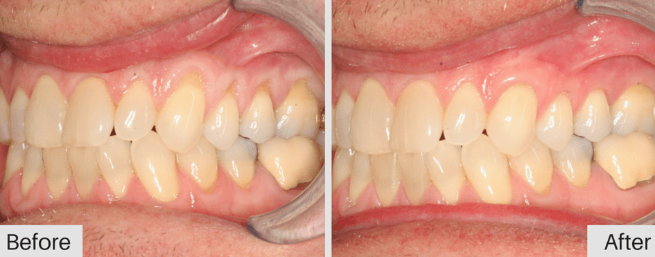 pinhole-gum-rejuvination1