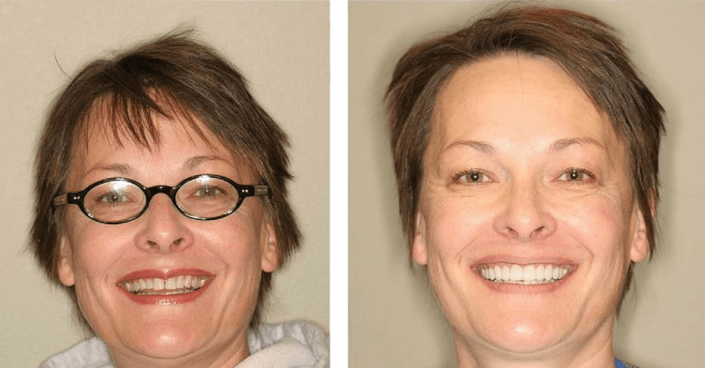 improve your smile no prep veneers