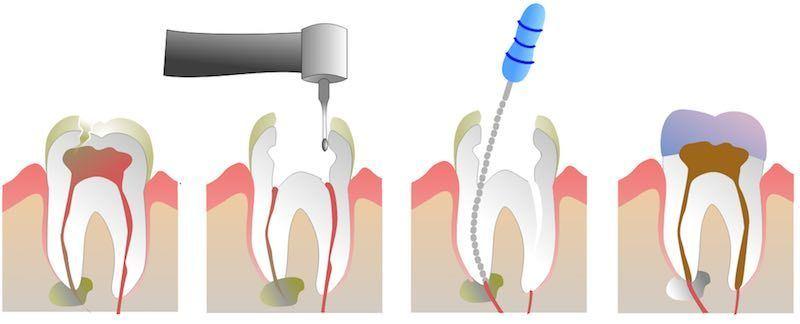 root-canal-therapy (1) Root canal therapy