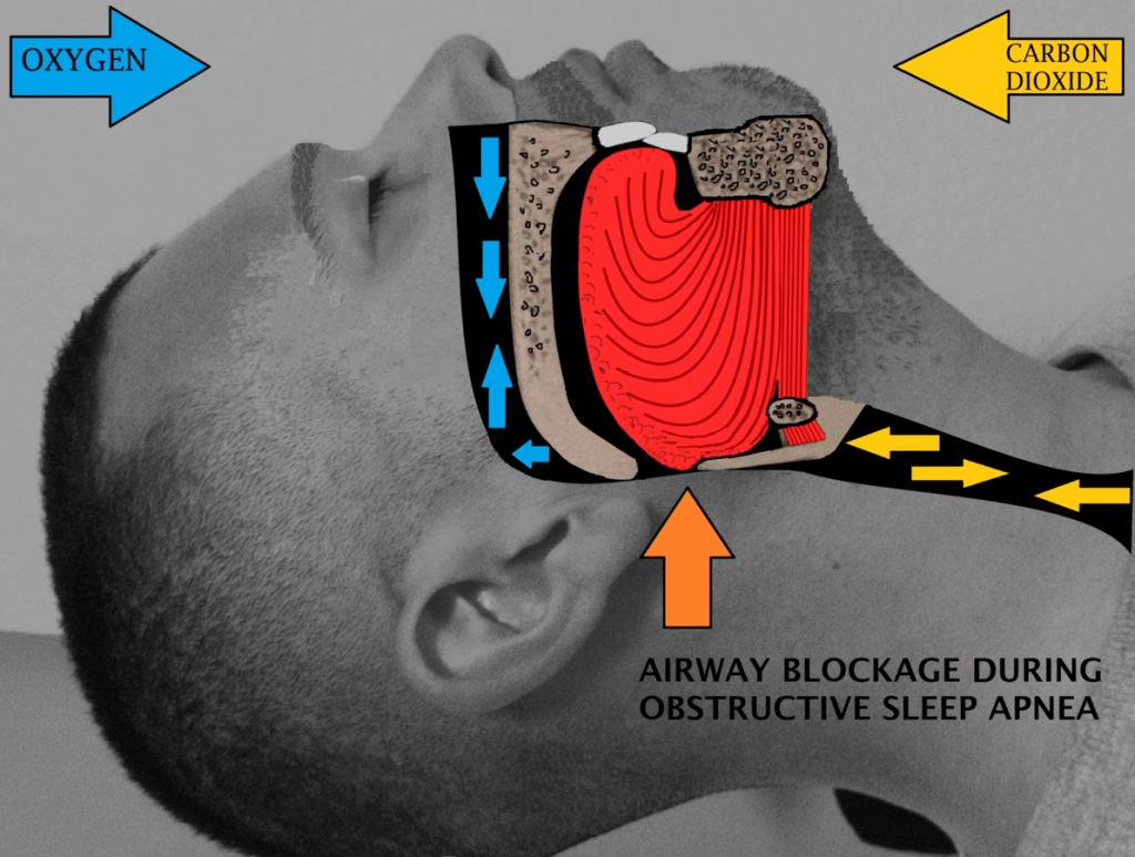 sleep-apnea-airway-obstruction-1024x773 sleep apnea an airway obstruction