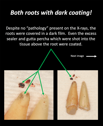 Dark Coating Root Canal Infection