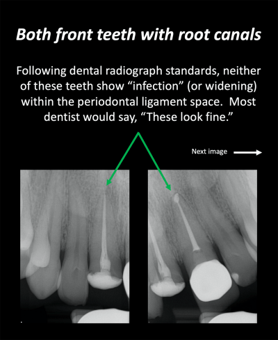 Toxic Tuesday X Ray Root Canal