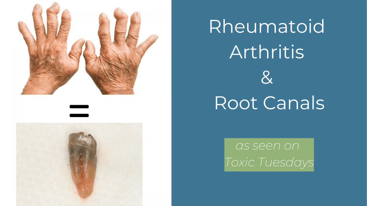 rheumatoid-arthritis-and-root-canal Rheumatoid Arthritis and Root Canals