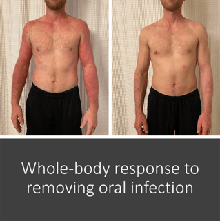 IMG_7551 Dental Mercury and Alzheimer's Disease