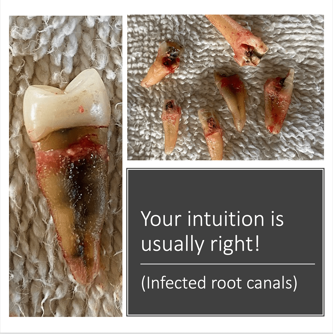 infected root canals trust your gut, go see a holistic dentist today