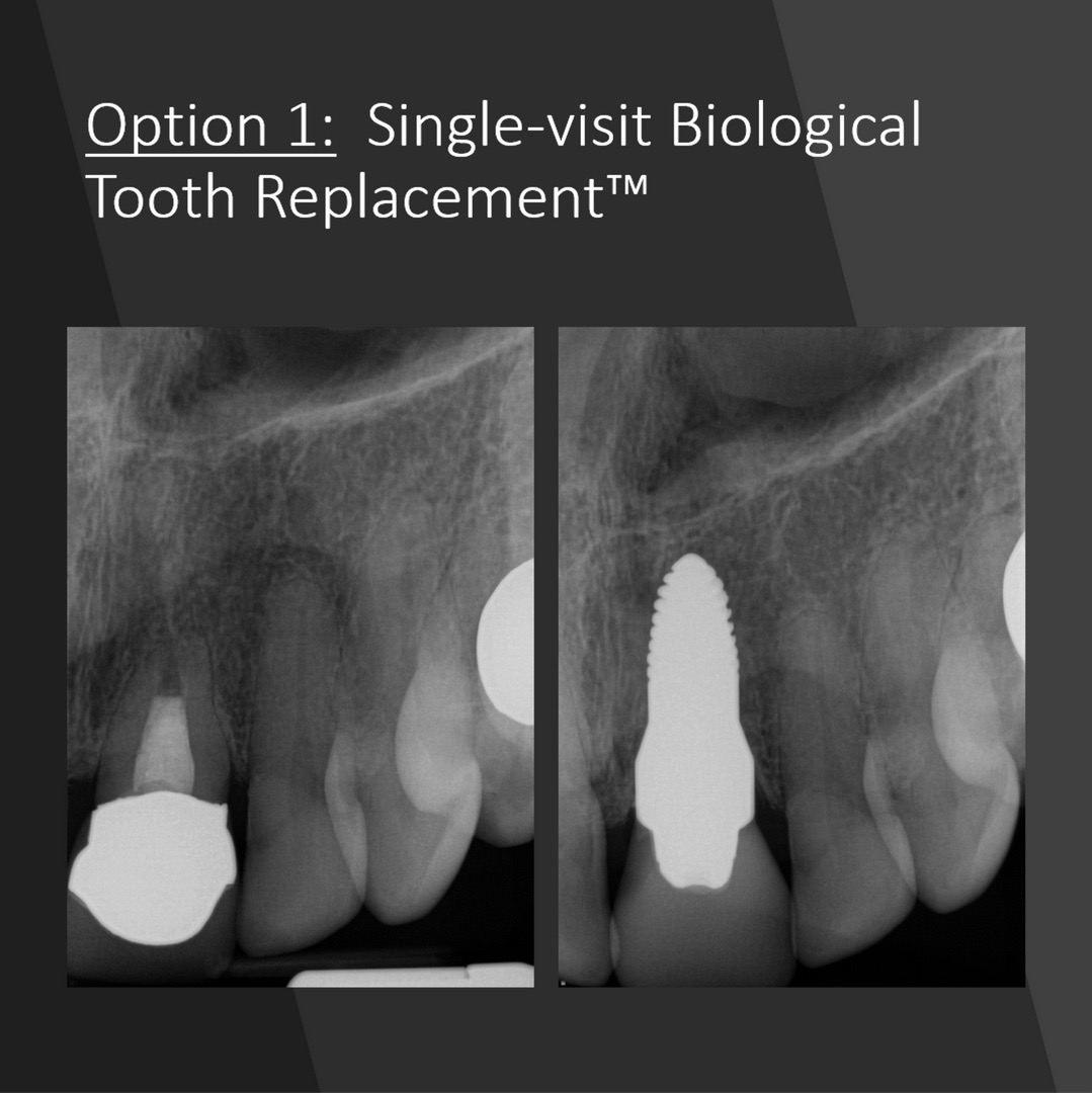 single visit biological tooth replacement