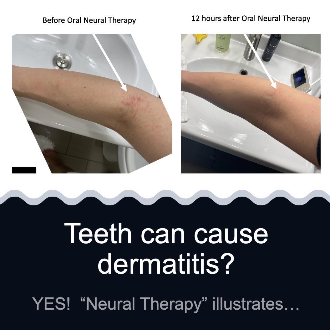 teeth can cause dermatitis