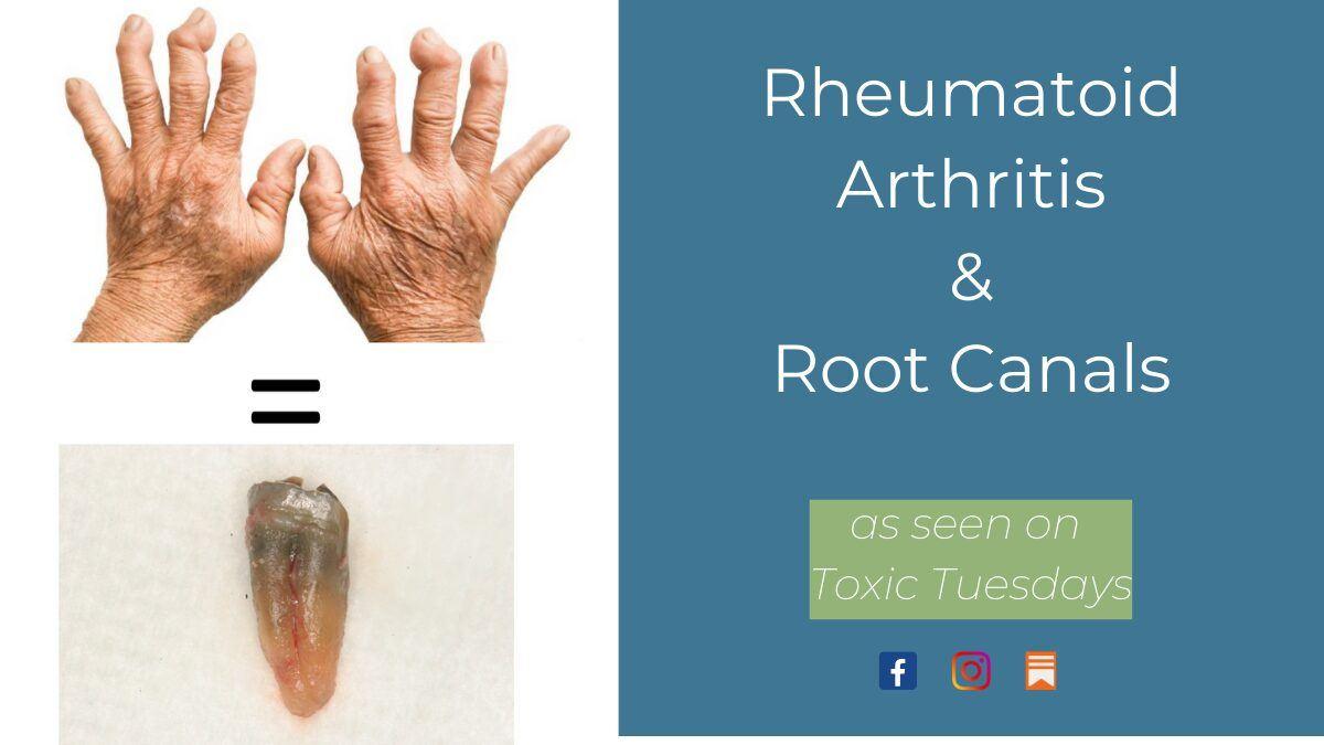 Rheumatoid Arthritis & Root Canals Updated (1) Rheumatoid Arthritis and Root Canals