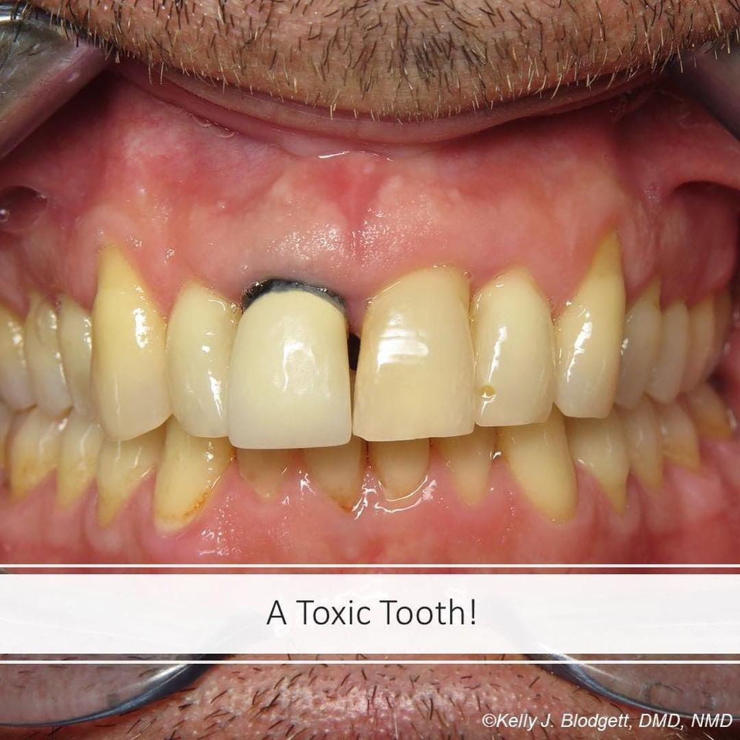 428640252_888724393048468_4258772815916414612_n Toxic Teeth or Tooth