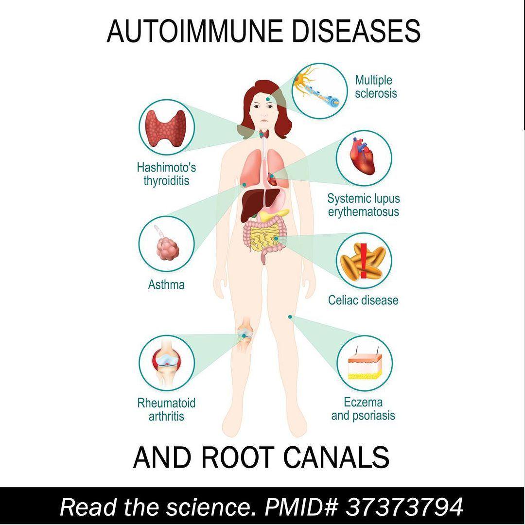 434250851_904606111460296_297978610409951960_n Autoimmune Diseases and Root Canals