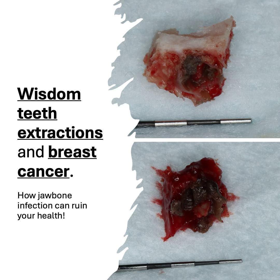 436210558_935145998406307_4954618667189632475_n Wisdom Teeth Extraction and breast cancer