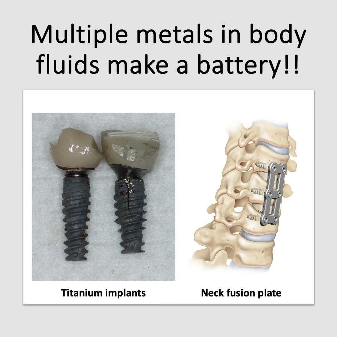 Multiple metals in body fluids make a battery