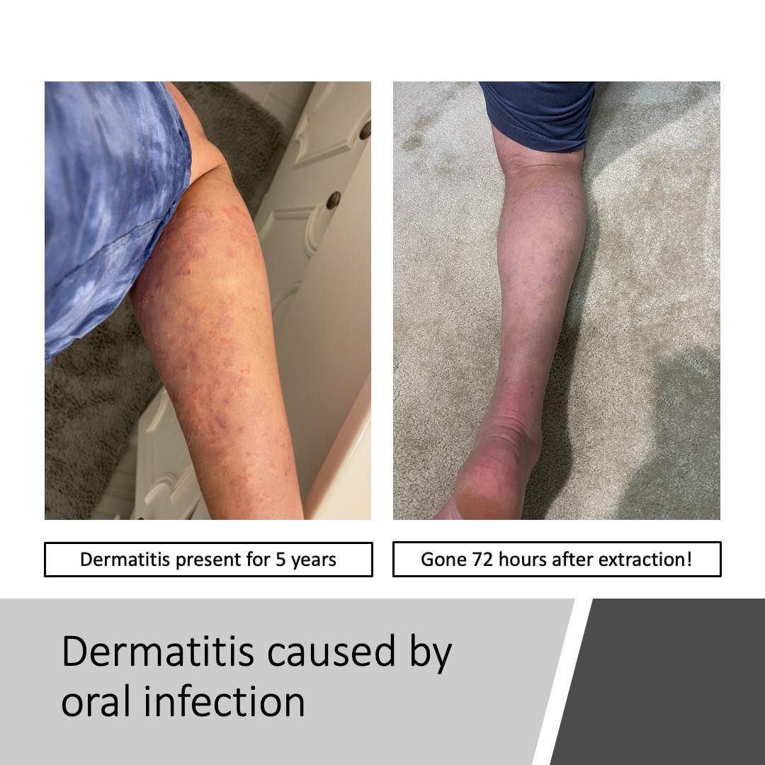 Dermatitis caused by oral infection