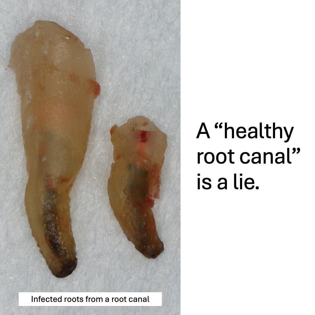 root canal lies