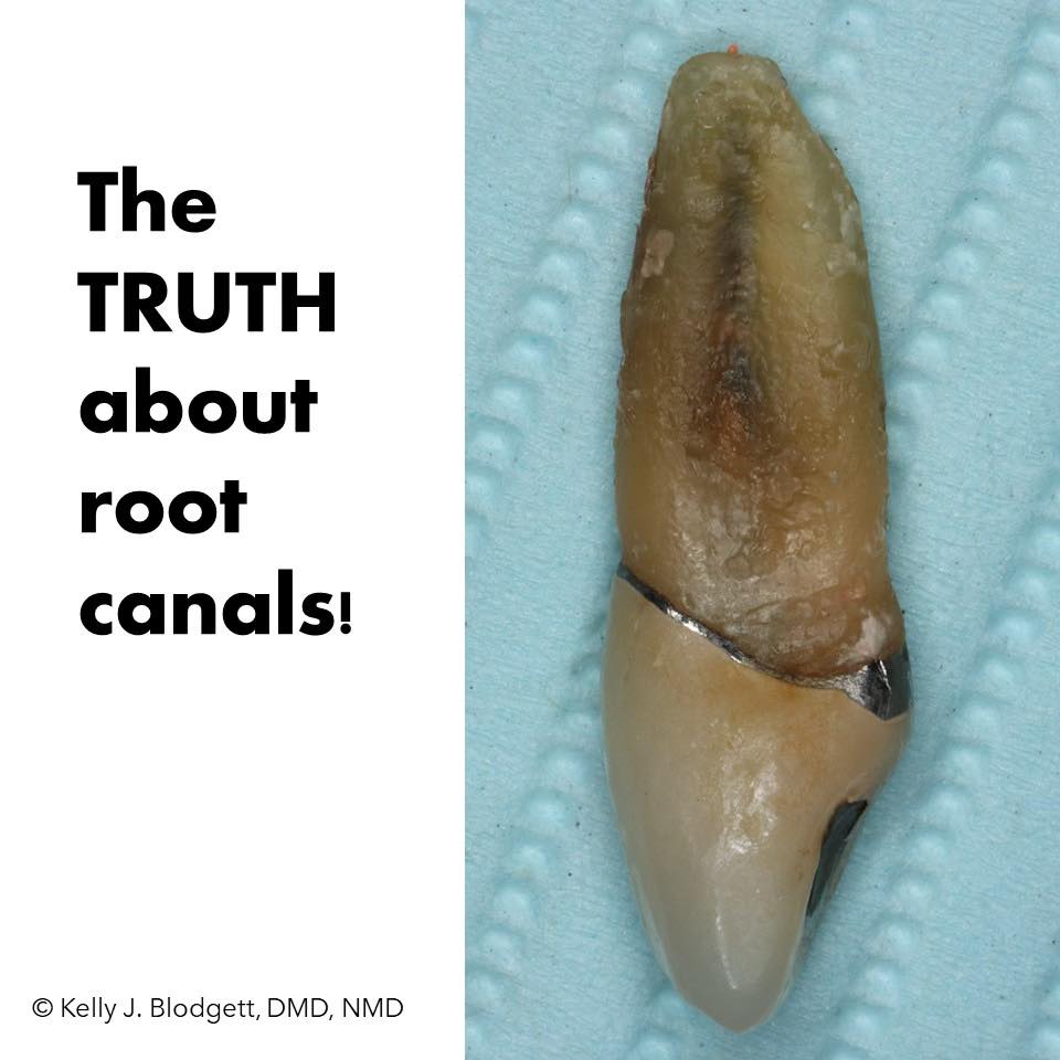 Truth about root canals