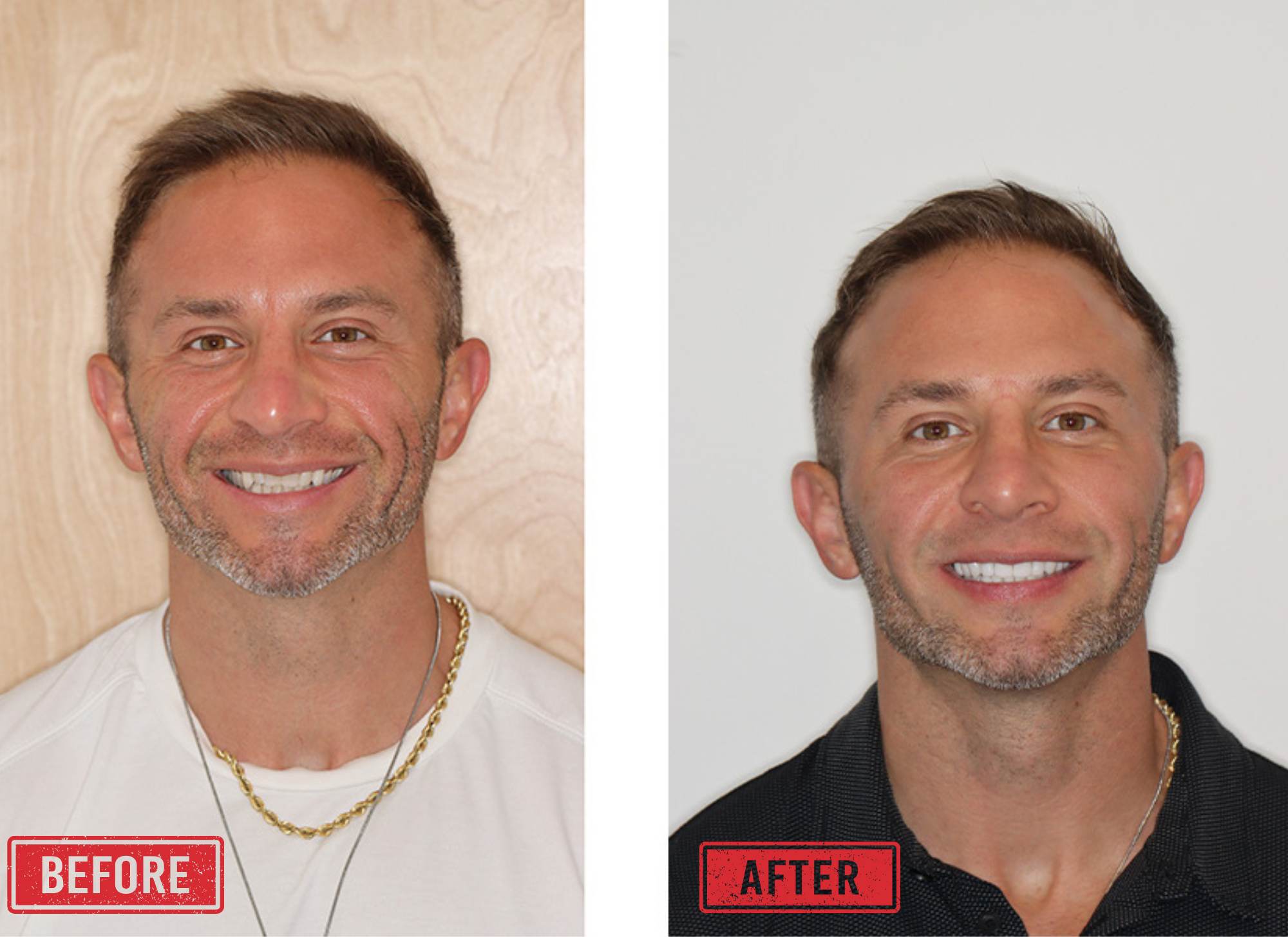 Before and after cosmetic dentistry Portland Oregon BDC Before and after cosmetic dentistry Portland Oregon BDC