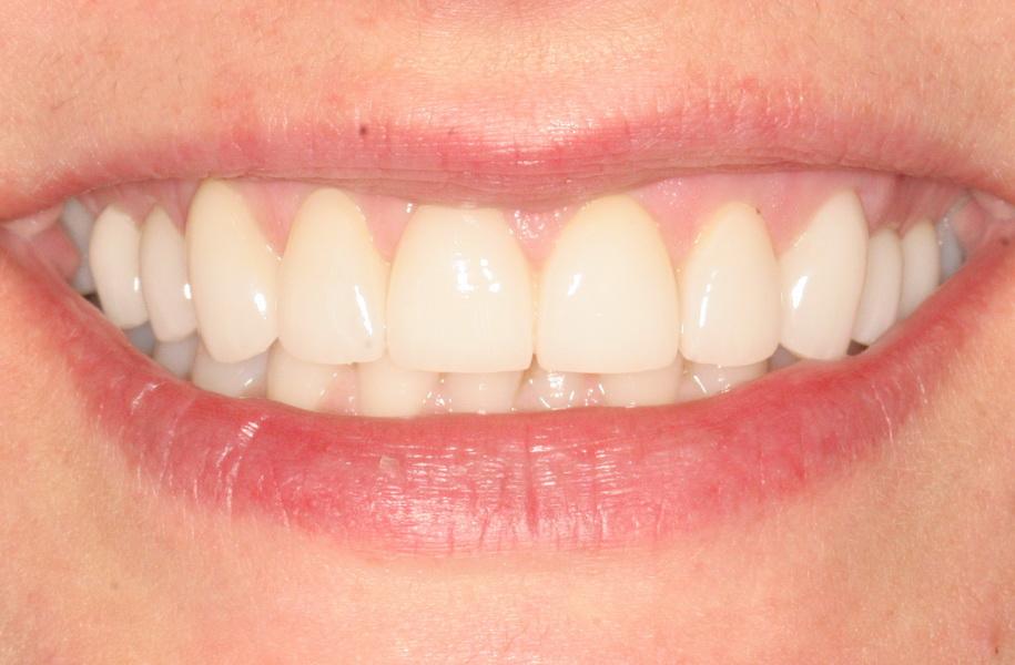 Biological Dental Rejuvenation New Smile