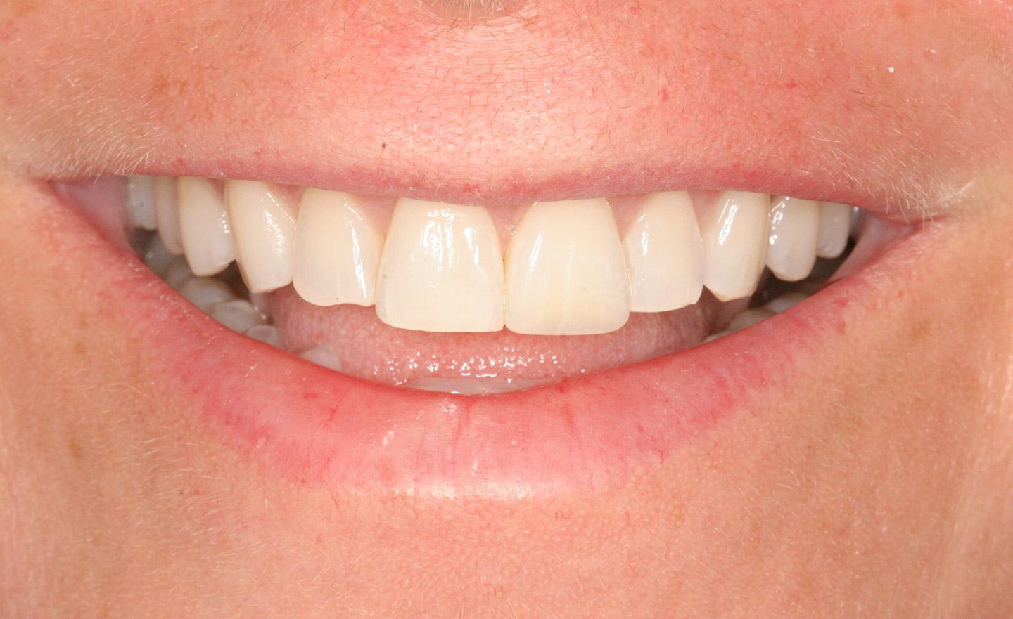 Ceramic Veneers